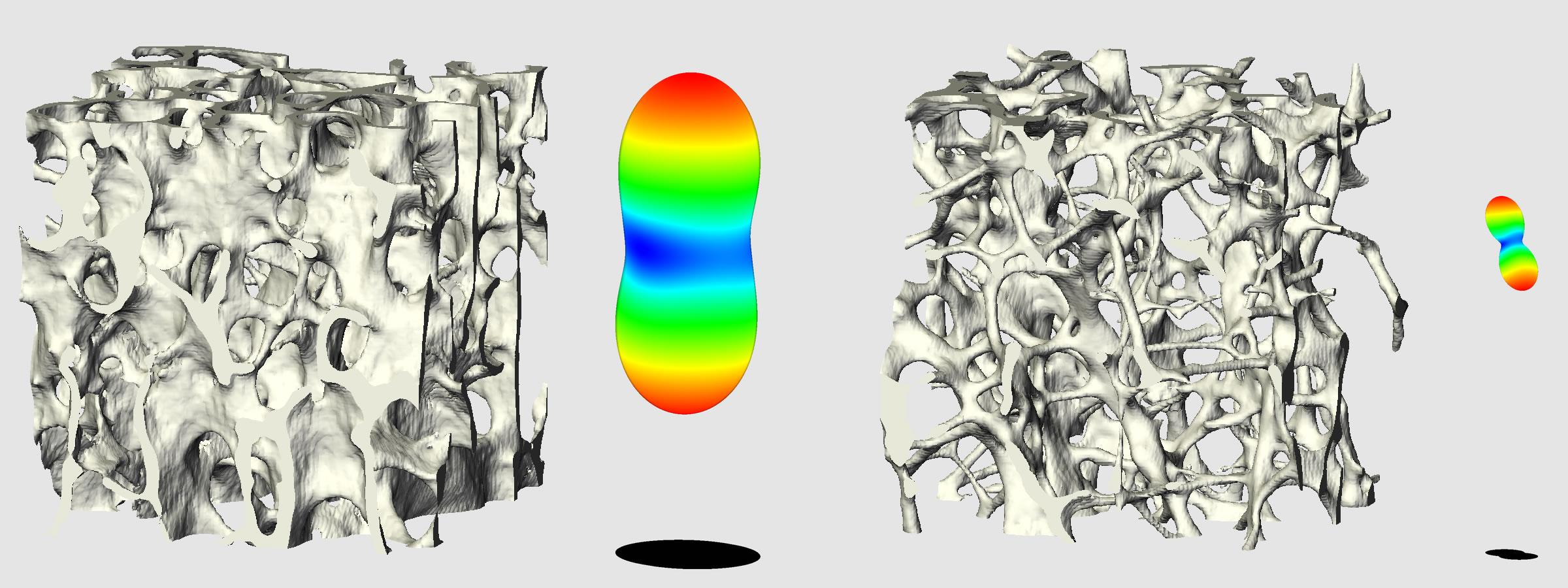 vertebral trabecular bone osteoporosis