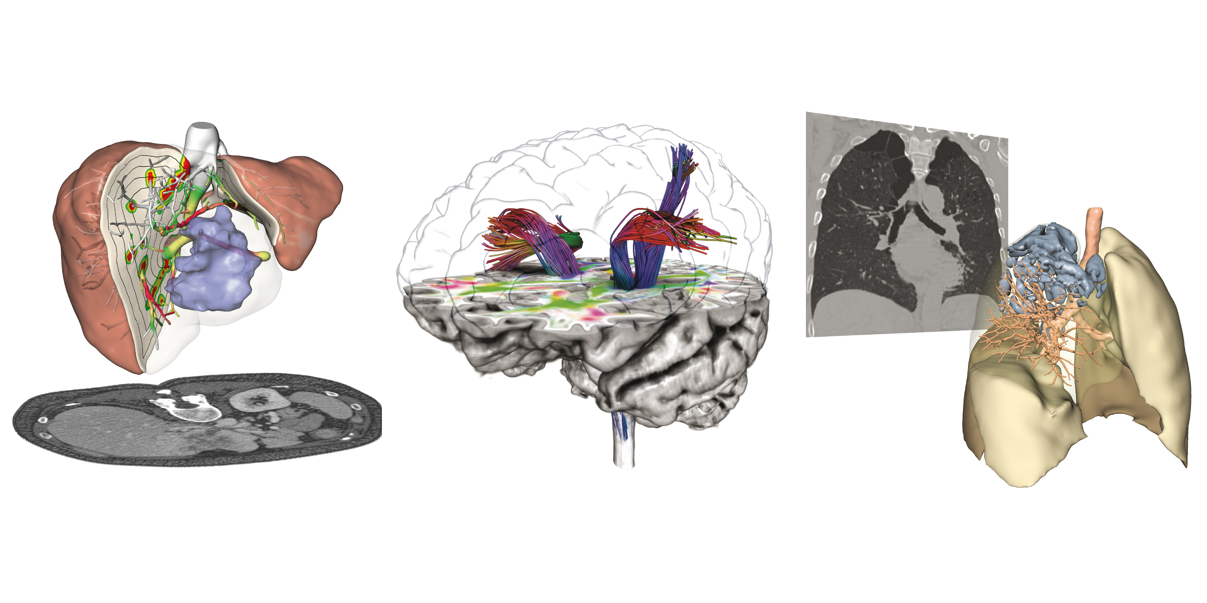 Turmors Liver Surgery Planning, Brain Nerve Fibers, Lung Turmors