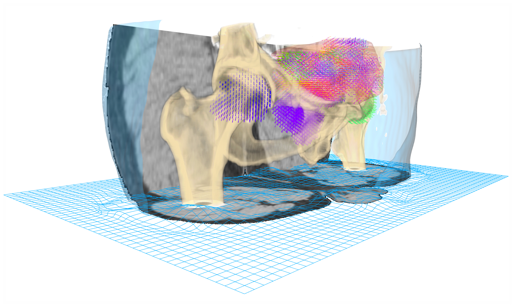 Registration with constraints Radiation Therapy 